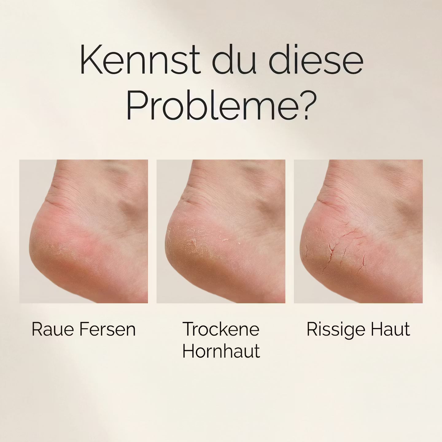 Electric callus remover